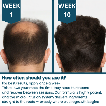 Hair loss treatment